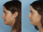 Revision Rhinoplasty