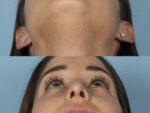 Revision Rhinoplasty