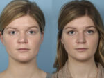 Revision Rhinoplasty