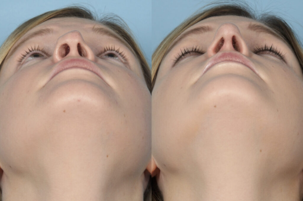 Revision Rhinoplasty