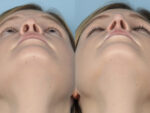 Revision Rhinoplasty