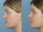 Revision Rhinoplasty