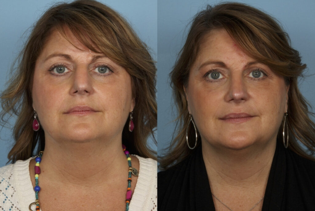 Revision Rhinoplasty