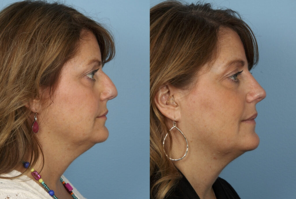 Revision Rhinoplasty