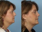 Revision Rhinoplasty