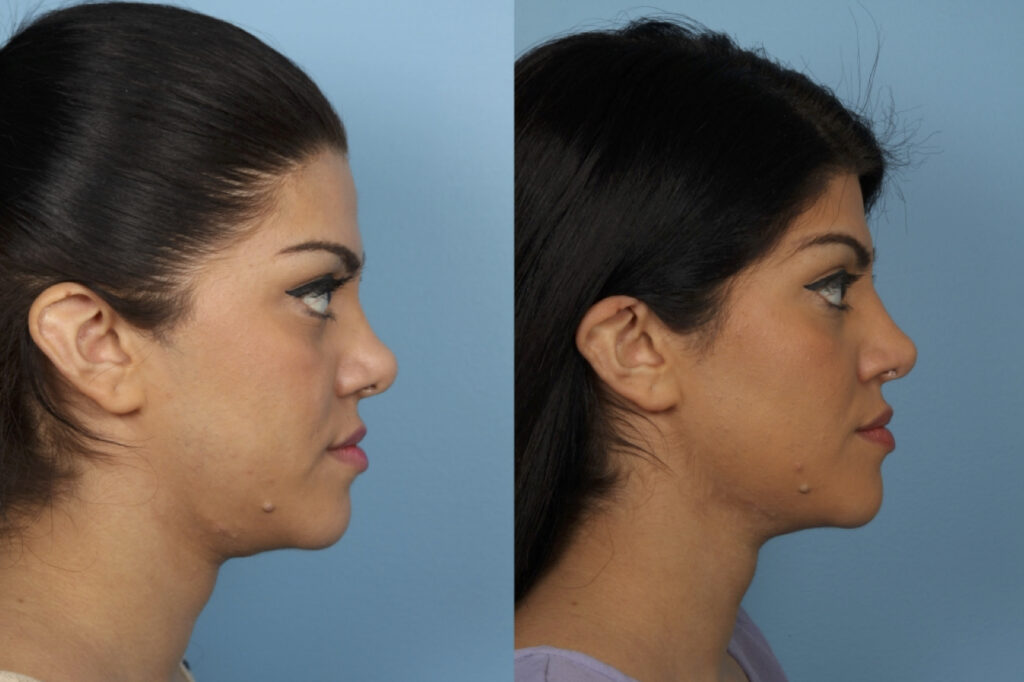 Revision Rhinoplasty