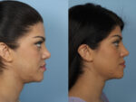 Revision Rhinoplasty