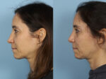 Revision Rhinoplasty