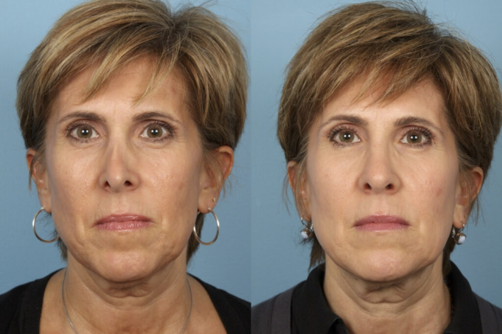 Revision Rhinoplasty