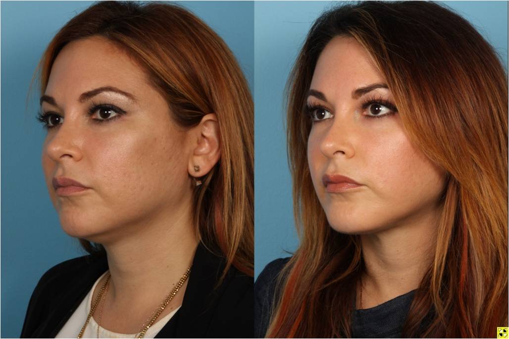 Face Liposuction Before And After
