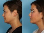 Chin and Submental Liposuction