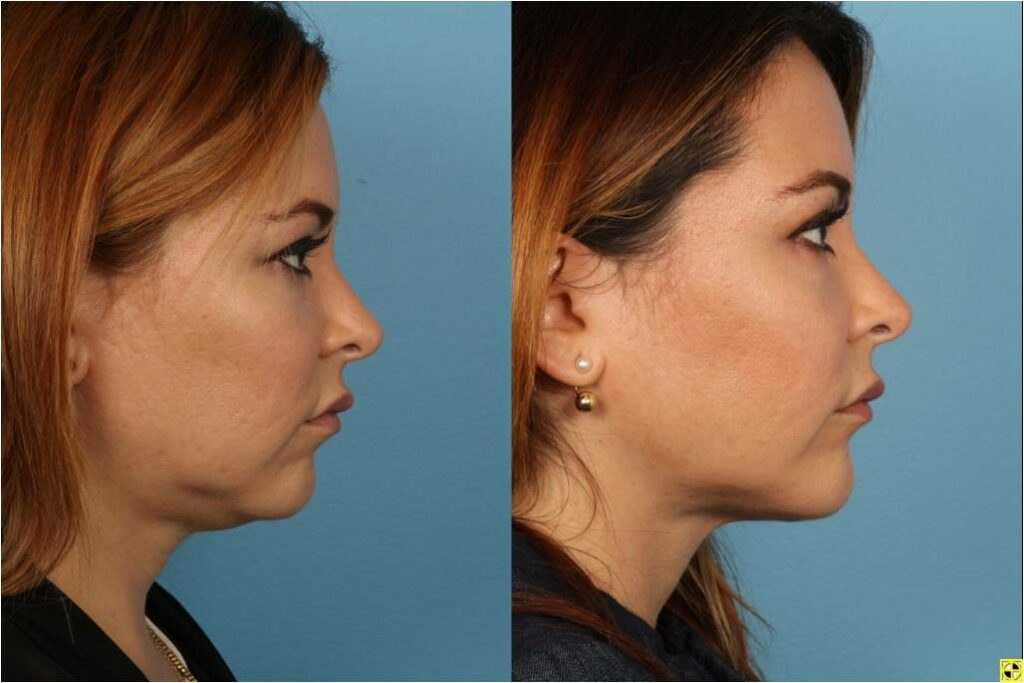 Chin and Submental Liposuction