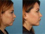 Chin and Submental Liposuction