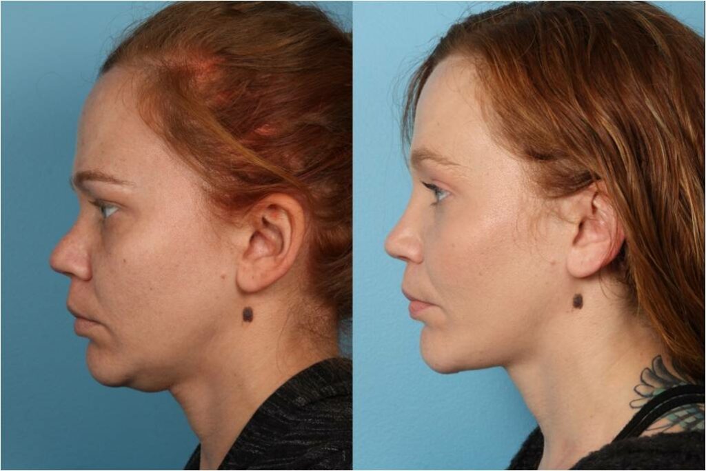 Chin and Submental Liposuction