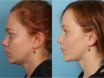 Chin and Submental Liposuction