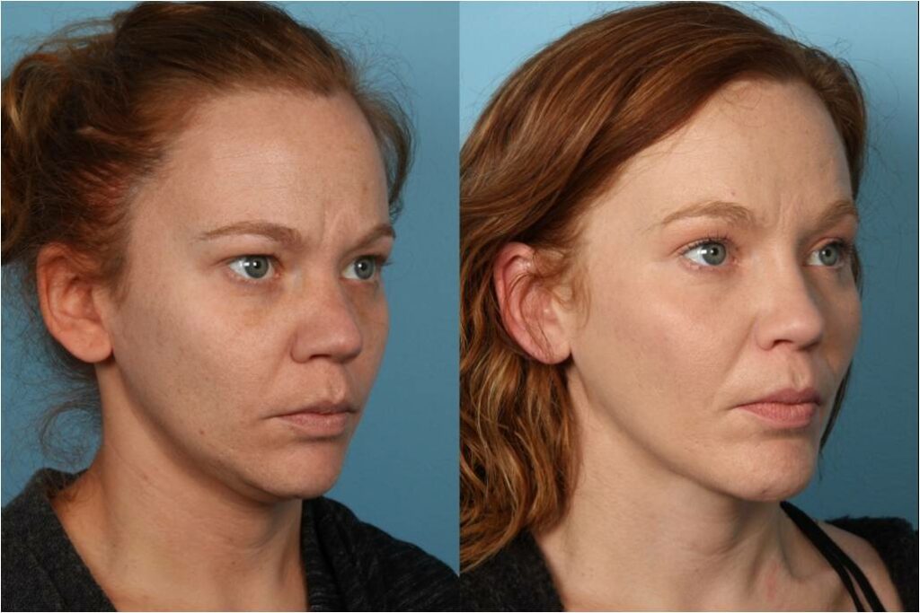 Chin and Submental Liposuction