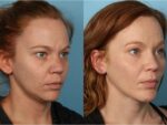 Chin and Submental Liposuction