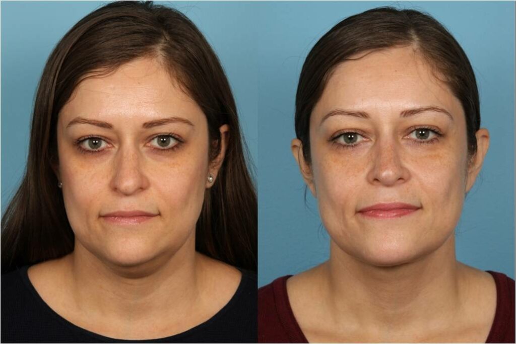 Chin and Submental Liposuction