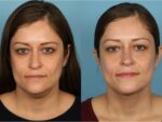 Chin and Submental Liposuction