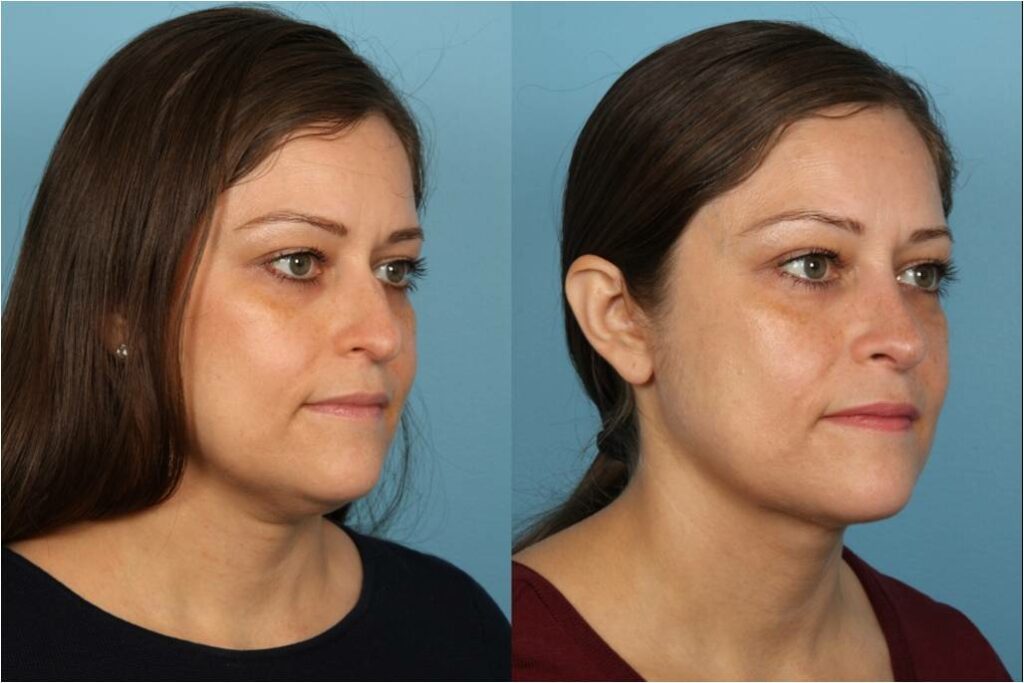Chin and Submental Liposuction