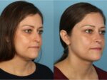 Chin and Submental Liposuction