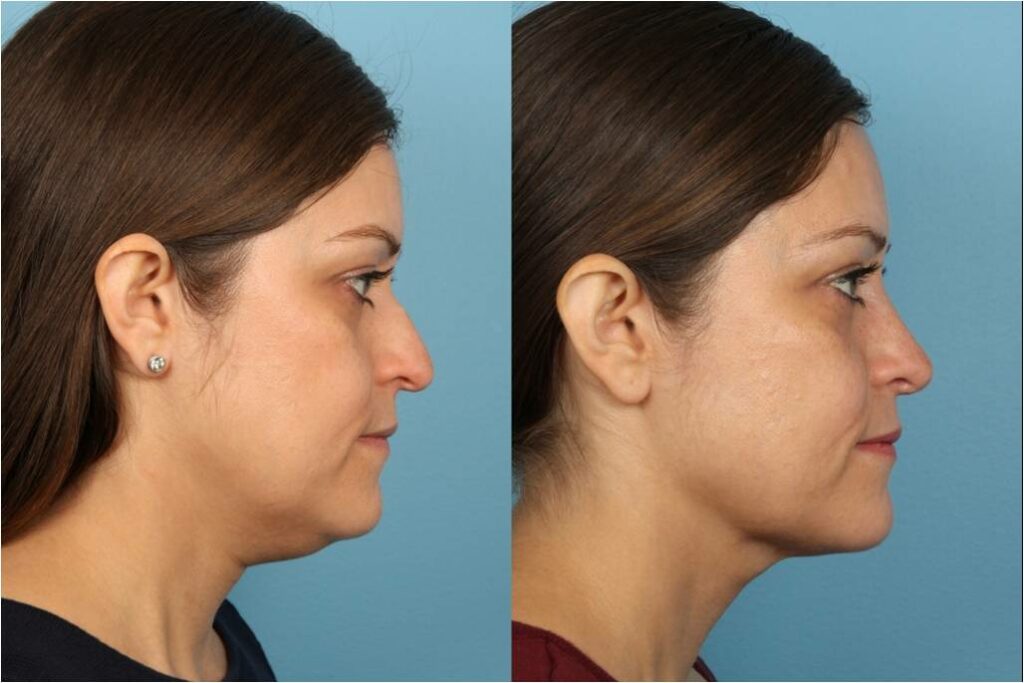 Chin and Submental Liposuction