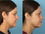 Chin and Submental Liposuction