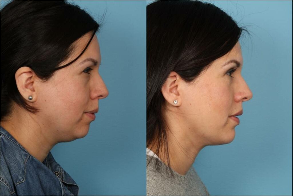 Chin and Submental Liposuction