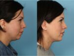 Chin and Submental Liposuction