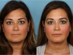 Chin Augmentation