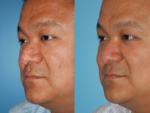 Rhinophyma- Before and After Photo
