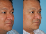 Rhinophyma- Before and After Photo