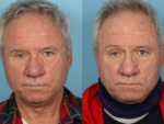 Rhinophyma- Before and After Photo