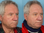 Rhinophyma- Before and After Photo