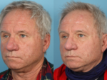 Rhinophyma- Before and After Photo