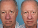 Rhinophyma- Before and After Photo