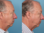 Rhinophyma- Before and After Photo