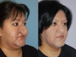 Rhinophyma- Before and After Photo