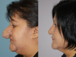 Rhinophyma- Before and After Photo