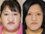 Rhinophyma- Before and After Photo