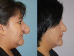 Rhinophyma- Before and After Photo