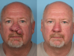 Rhinophyma- Before and After Photo