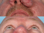 Rhinophyma- Before and After Photo