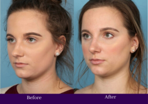 Rhinoplasty before and after