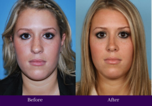 Before and after rhinoplasty