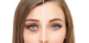 Eyelid Surgery