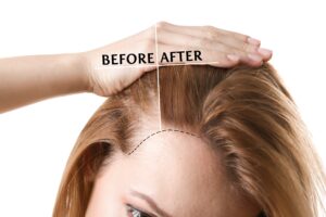 Forehead Reduction and Hairline Lowering Surgery