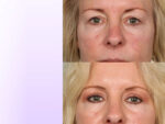 Skin Resurfacing