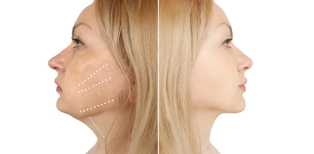 Neck Lift Surgery