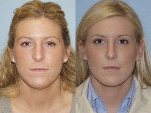 Aurora Nose Job Surgeon